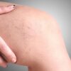 Are You at Risk of Developing Varicose Veins?