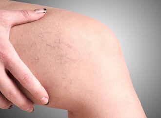 Are You at Risk of Developing Varicose Veins?