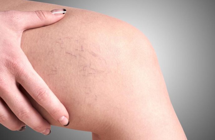 Are You at Risk of Developing Varicose Veins?