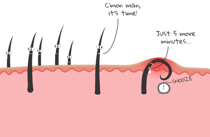 How to Remove Ingrown Hairs From Shaving