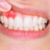 What Is Gingivitis and How Can You Avoid it