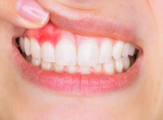 What Is Gingivitis and How Can You Avoid it