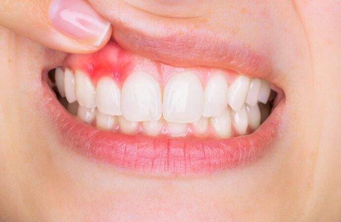 What Is Gingivitis and How Can You Avoid it